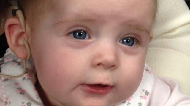 Youngest Cochlear Implant in UK for Evie Smith