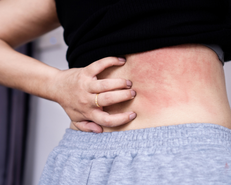 Eczema 1000 x 800